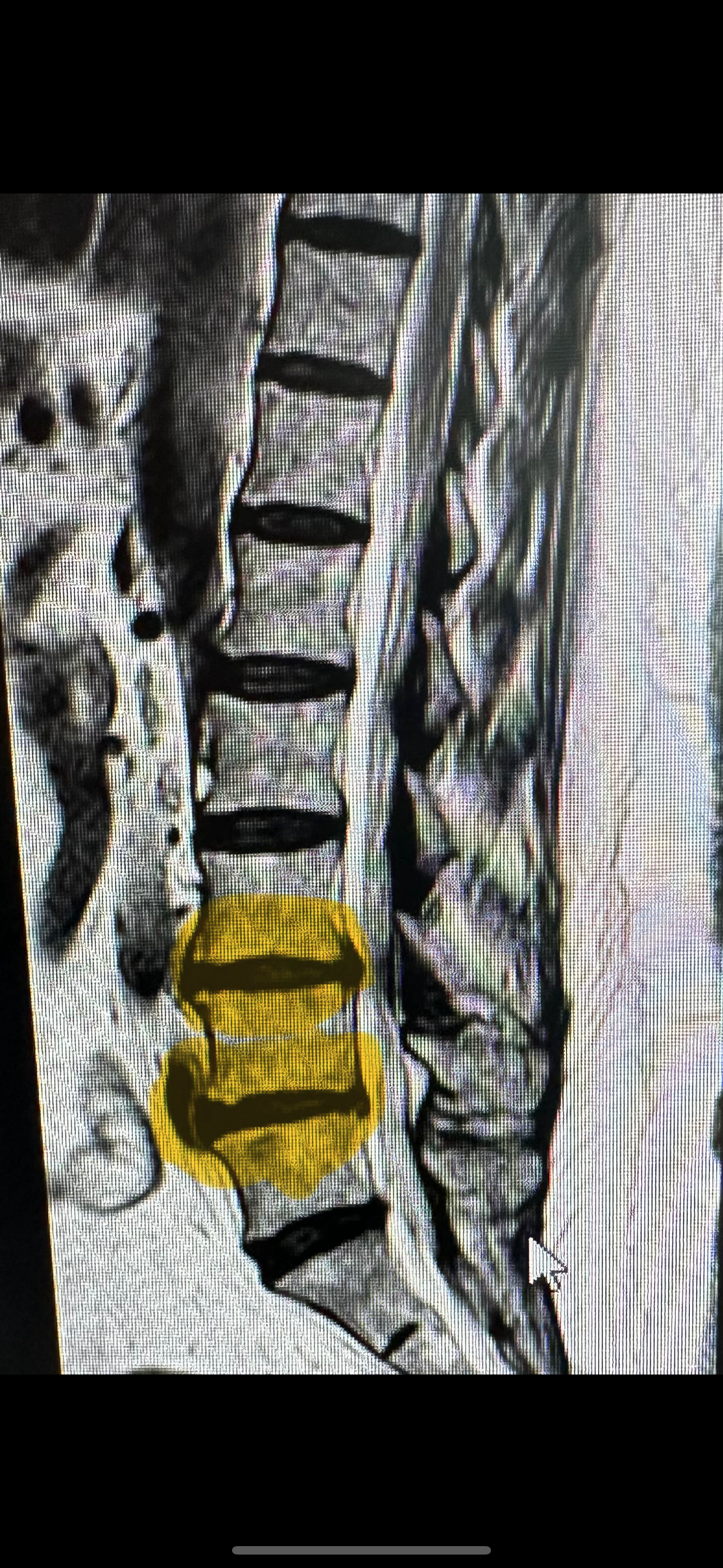 Diagrama de un disco herniado mostrando la compresión del nervio espinal